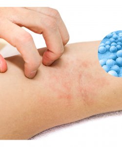  Itchy and redness skin in periods of exacerbation